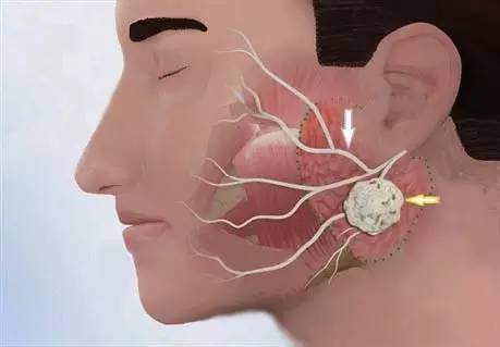 面瘫是怎么引起的 面瘫是怎么引起的